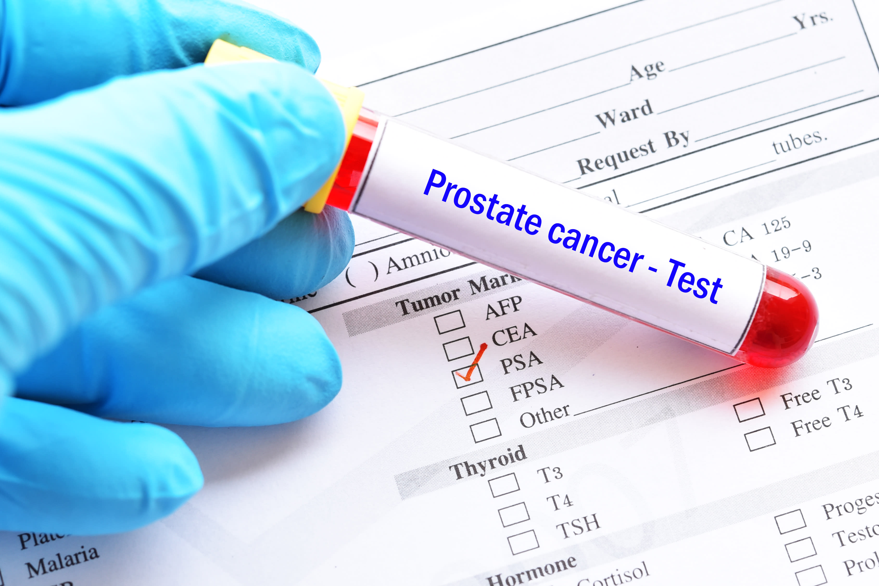 Prostate Cancer Diagnosed Via Ai 5120