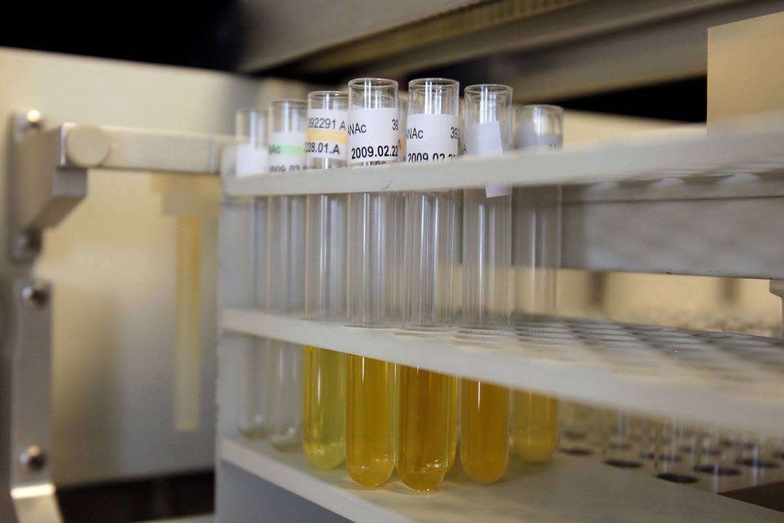 A urine test developed by researchers at the Nagoya University in Japan can pinpoint a person who has a brain tumor — regardless of its size or mali