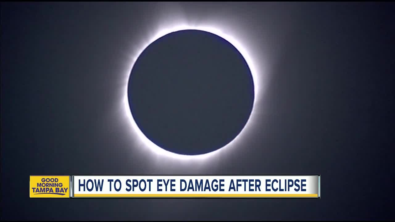 Solar eclipse Eye damage can show later [Video]