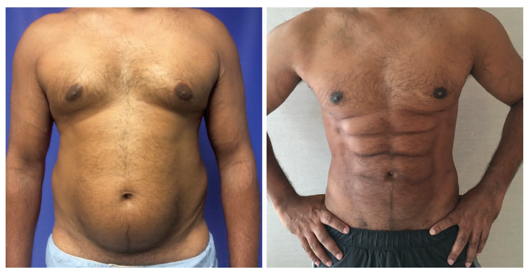 This Plastic Surgery Procedure That Promises To Give You Six Pack Abs