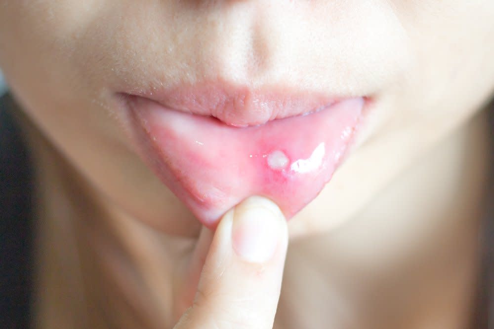 This Is When Your Canker Sore Is Something More Serious