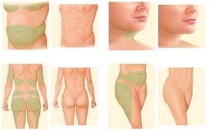 ▷ Tummy Tuck vs Liposuction: Which Procedure is Right for You?