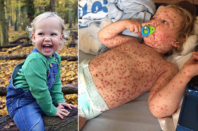 chicken pox vaccine after effects