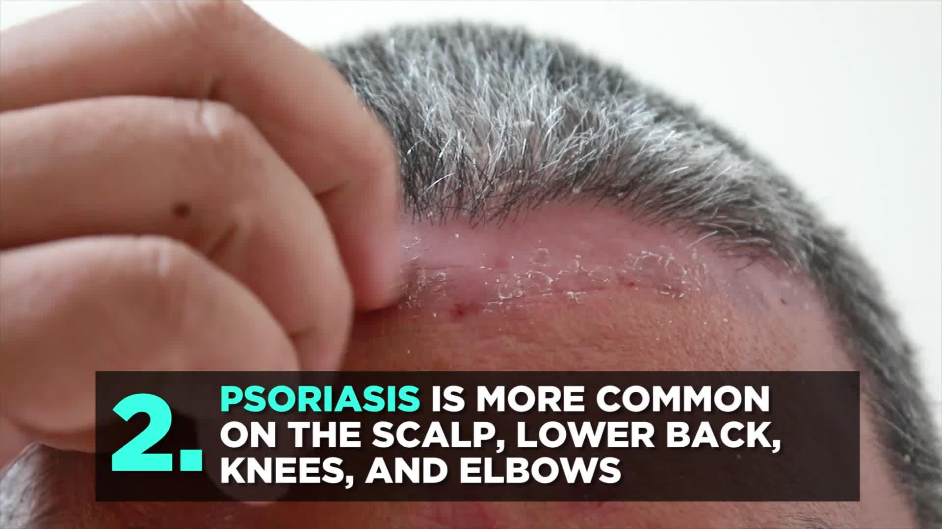 What is Inverse Psoriasis—and What's the Best Way to Treat It?