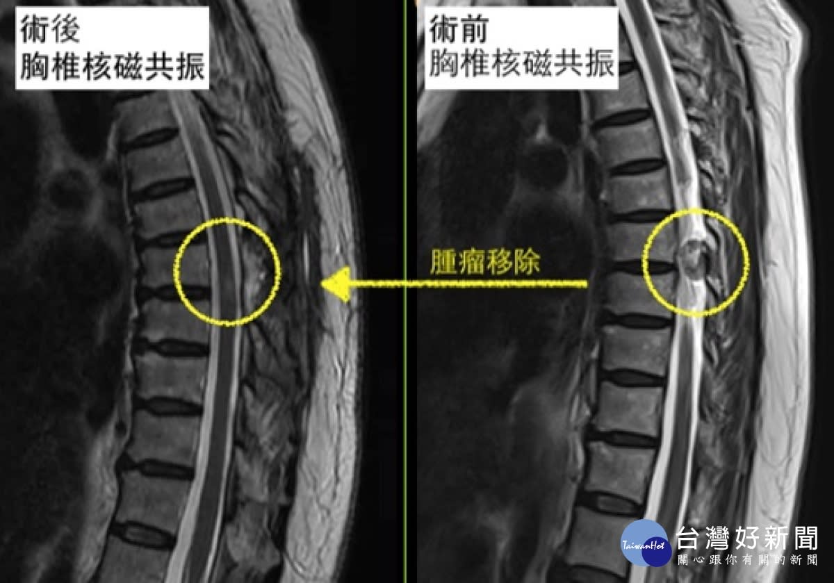 下肢麻木不一定是腰椎退化醫師 小心脊椎腫瘤