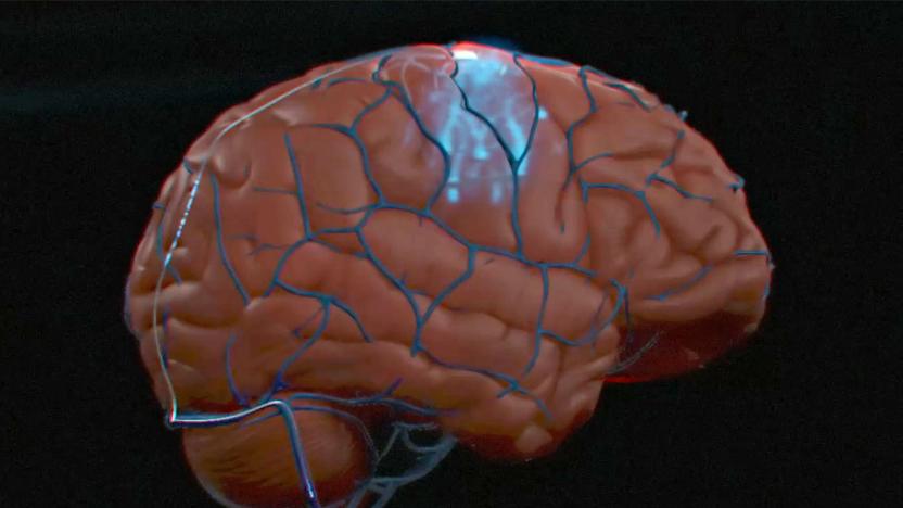 A computer graphics rendering of the Synchron Stentrode brain-computer interface implant.