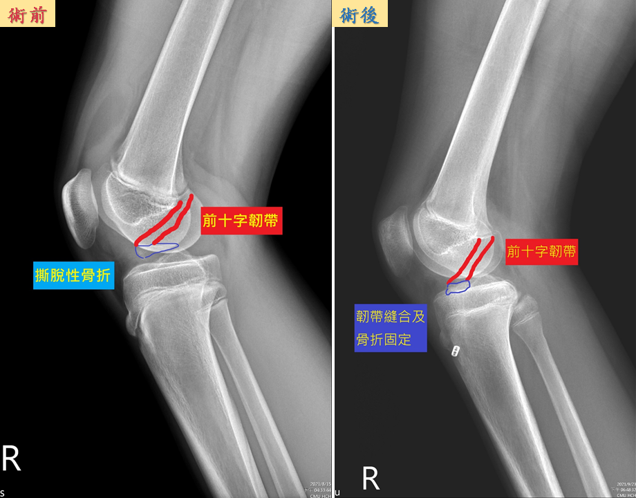 解封後學童運動骨折多醫三點提醒