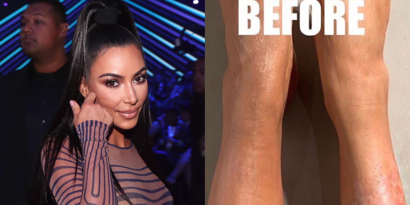 Kim Kardashian Reveals How She Manages Her Psoriasis In A Super Honest