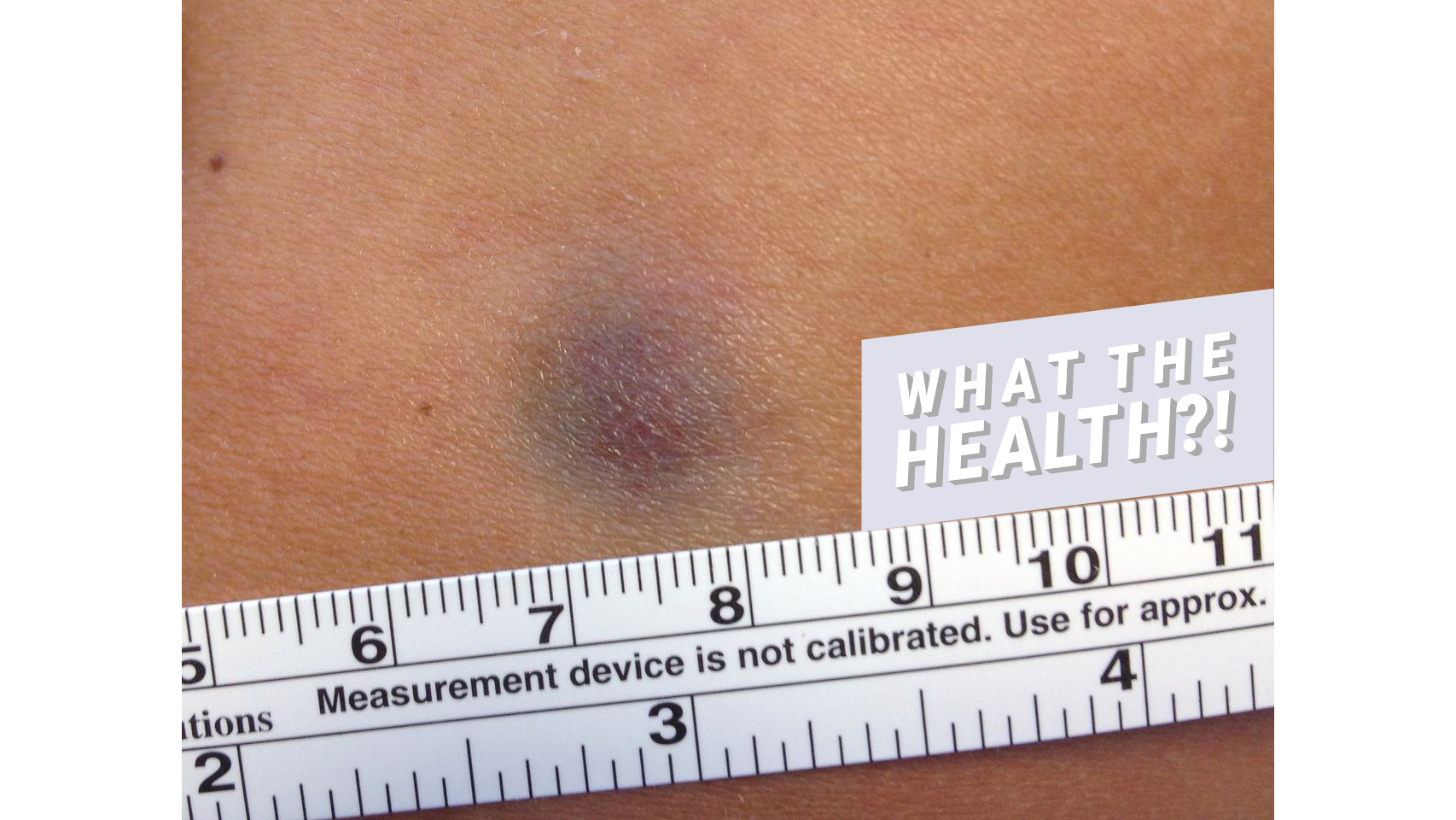 this-woman-s-tiny-bruise-turned-out-to-be-a-rare-form-of-skin-cancer