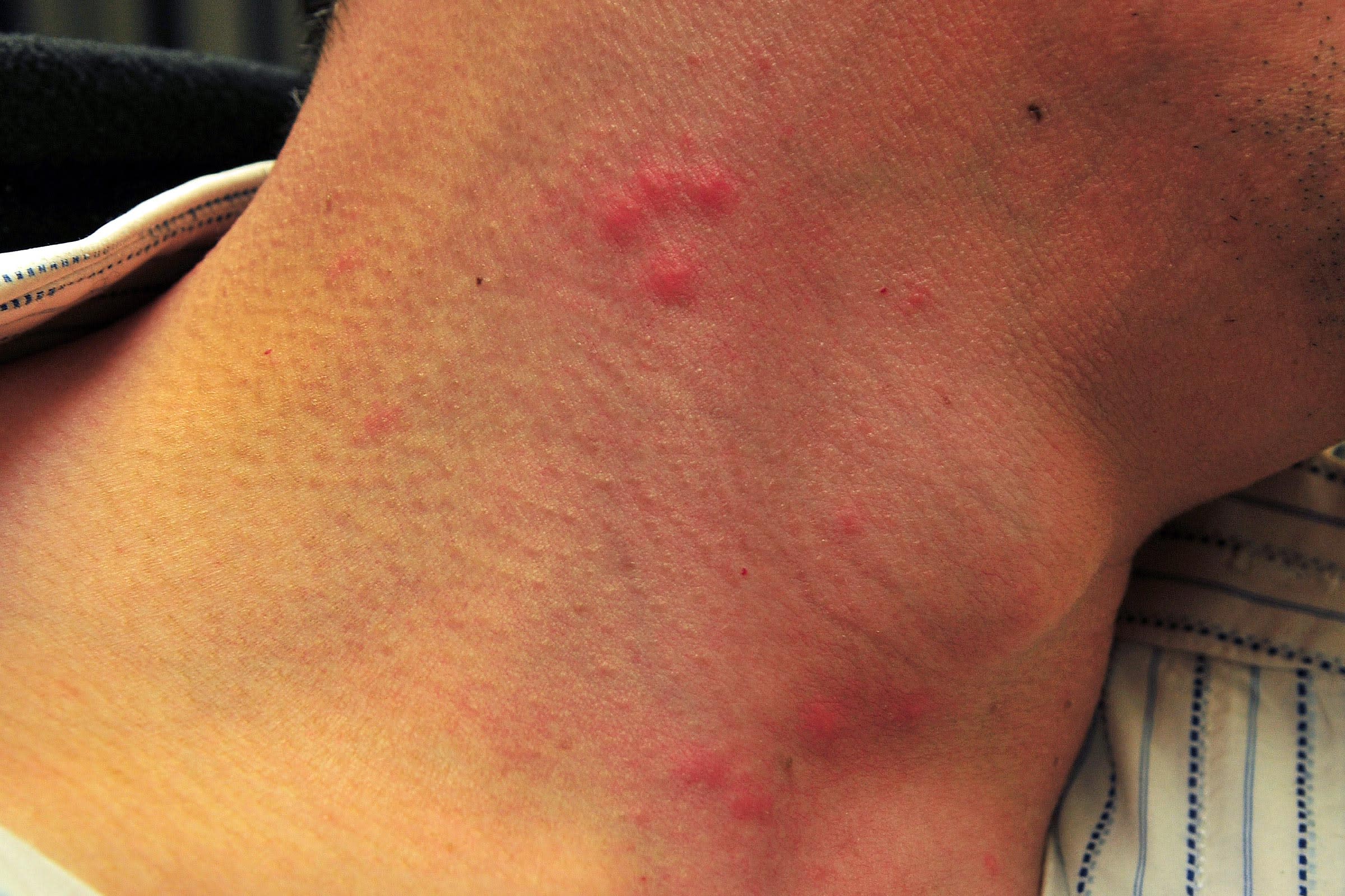 bed bug bites clean mattress