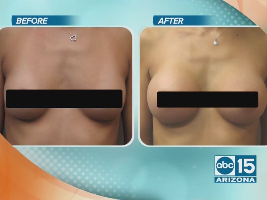 larz Breast augmentation dr