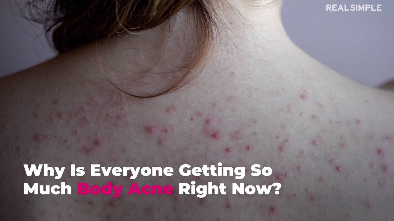 Ask a Dermatologist: Why Am I Getting So Much Body Acne?