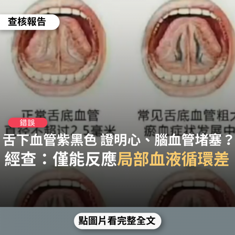 錯誤 網傳影片稱 舌下血管瘀血成紫黑色 代表心腦血管堵塞