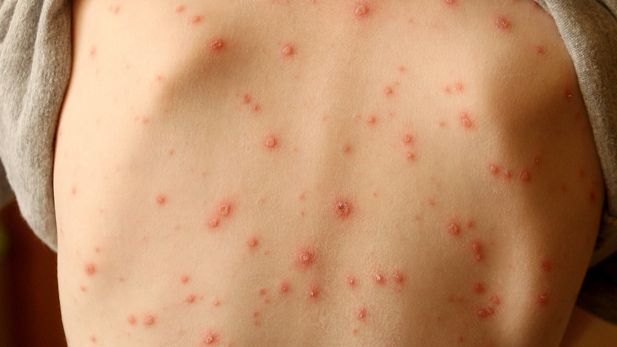 skin-rash-should-be-considered-key-symptom-of-coronavirus-say-scientists