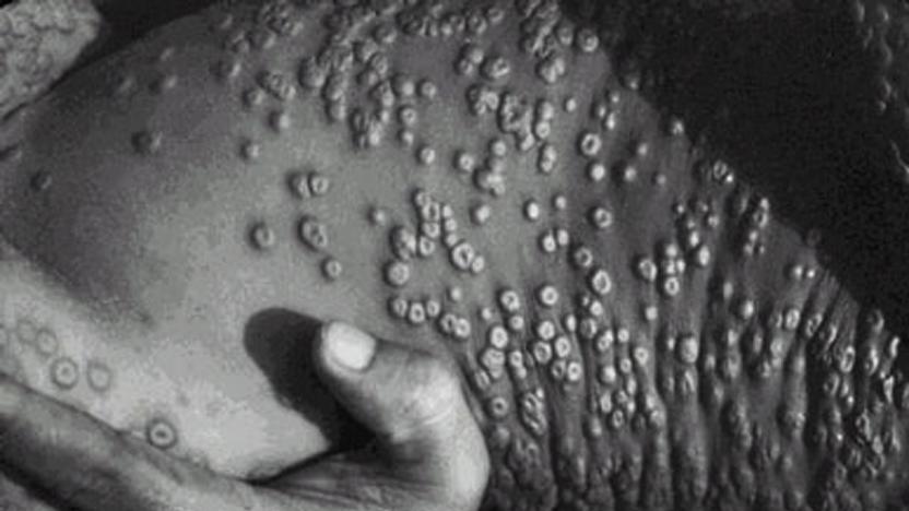 Smallpox lesions on skin are shown in this photograph taken in 1973  in Bangladesh. Smallpox infection was eliminated from the world in 1977. Smallpox is caused by variola virus with an incubation period of about 12 days following exposure. Initial symptoms include high fever, fatigue, and head and back aches. A characteristic rash, most prominent on the face, arms, and legs, follows in 2-3 days. The rash starts with flat red lesions that evolve at the same rate. Lesions become pus-filled and begin to crust early in the second week. Scabs develop and then separate and fall off after about 3-4 weeks. The majority of patients with smallpox recover, but death occurs in up to 30% of cases. Routine vaccination against smallpox ended in 1972.  
&W ONLY