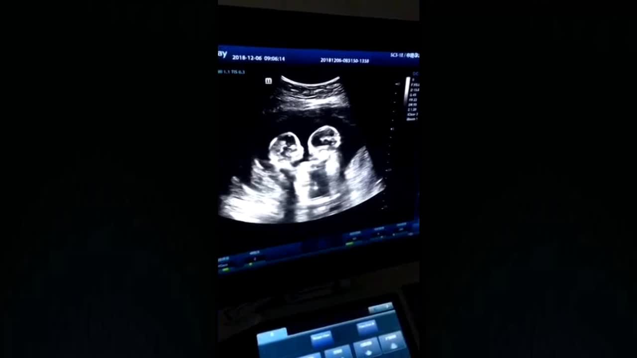 ultrasound twins