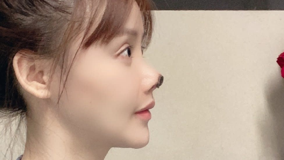 Chinese star Gao Liu shares photos of ‘nightmare’ nose surgery