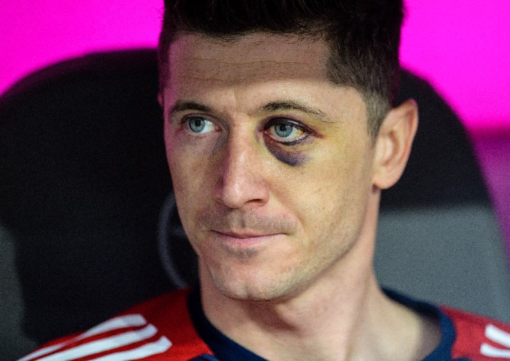 Eye, eye! Bayern star Lewandowski sports a shiner