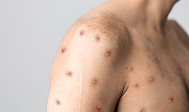 Le traitement du Monkeypox entraîne des épidémies d’IST, selon les prestataires de soins de santé sexuelle