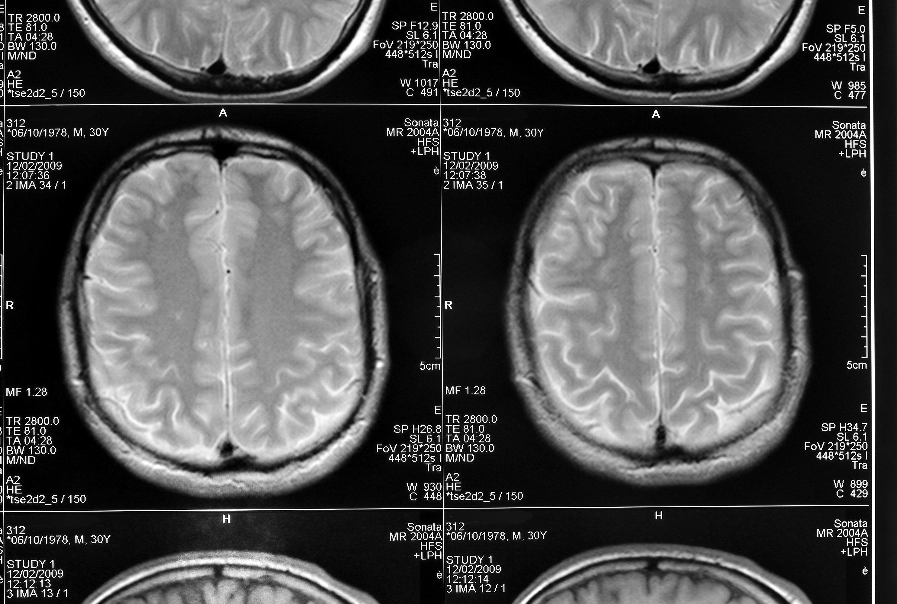 Munchausen Syndrome By Proxy The Rare Mental Health Problem Behind The 4774