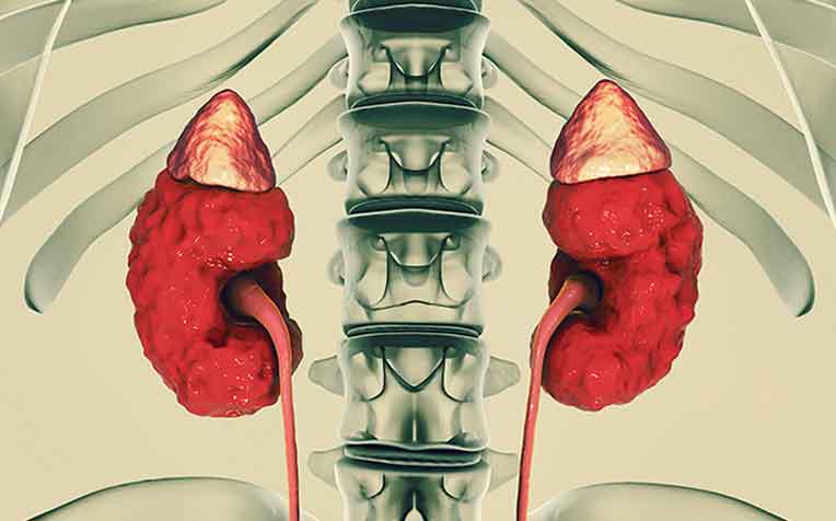 Second Most Common Cause of Kidney Disease that Many are Unaware of