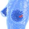 Tumori: test del sangue prevede ricadute cancro seno