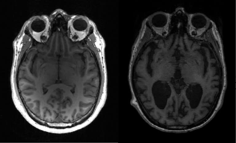 Wetenschappers hebben de oorzaak van de ontwikkeling van de ziekte van Alzheimer in de hersenen ontdekt