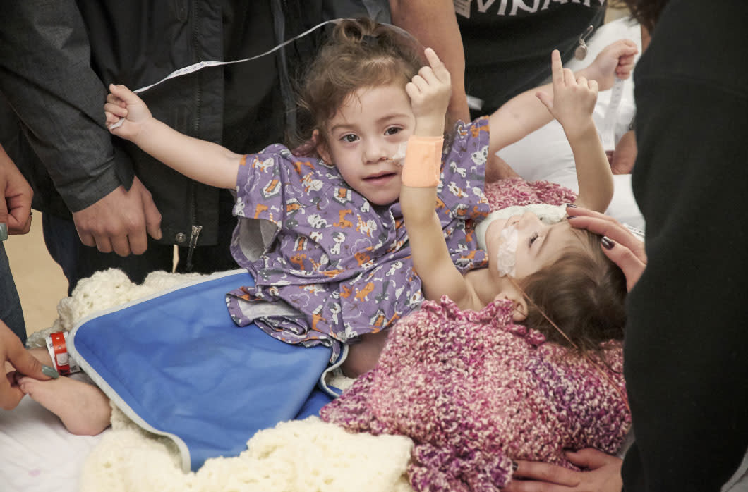 Conjoined Twin Girls Successfully Separated