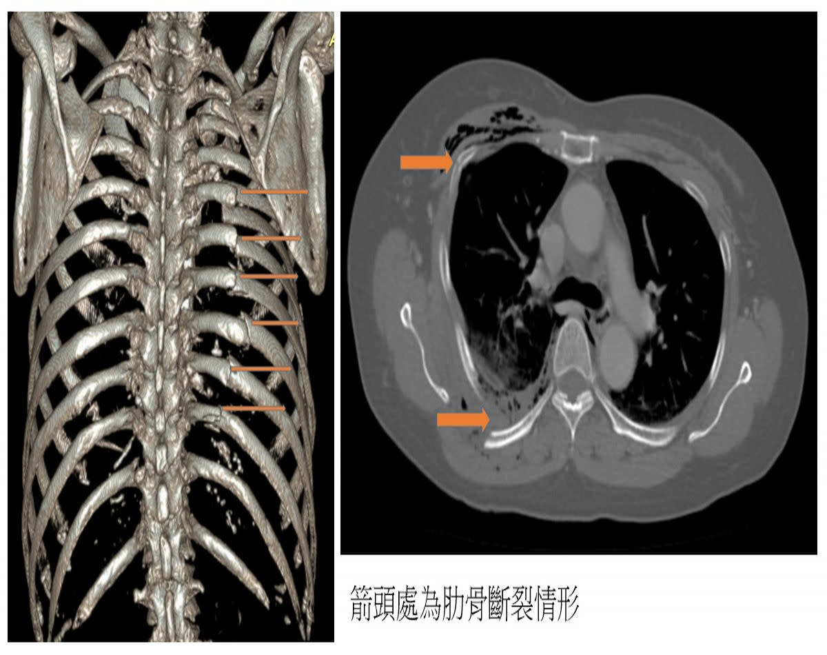 婦人樓梯跌落斷12根肋骨鈦合金骨折固定術防肺臟損傷