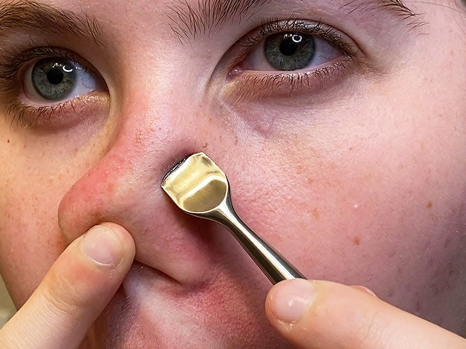 Popping a pimple in the 'triangle of death' could lead to serious infection, acc..