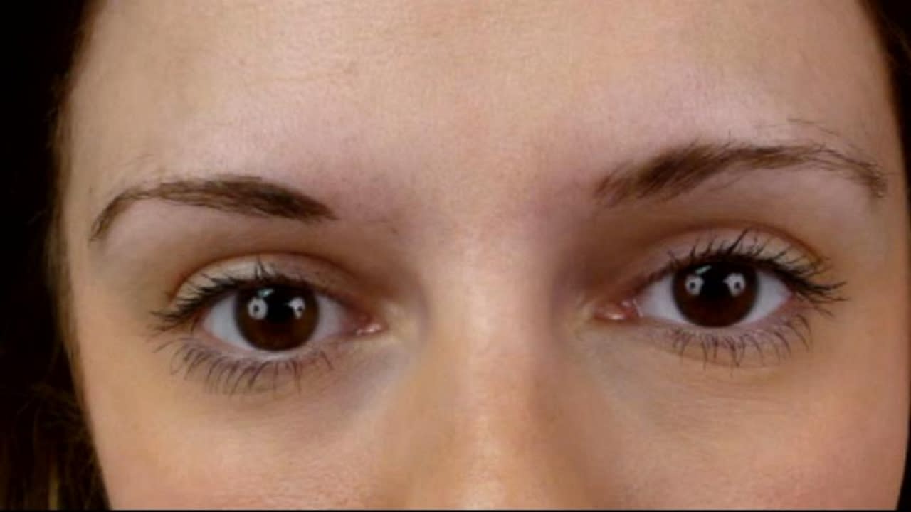 Eyebrow Transplants Enhance Fullness in Thinning Brows