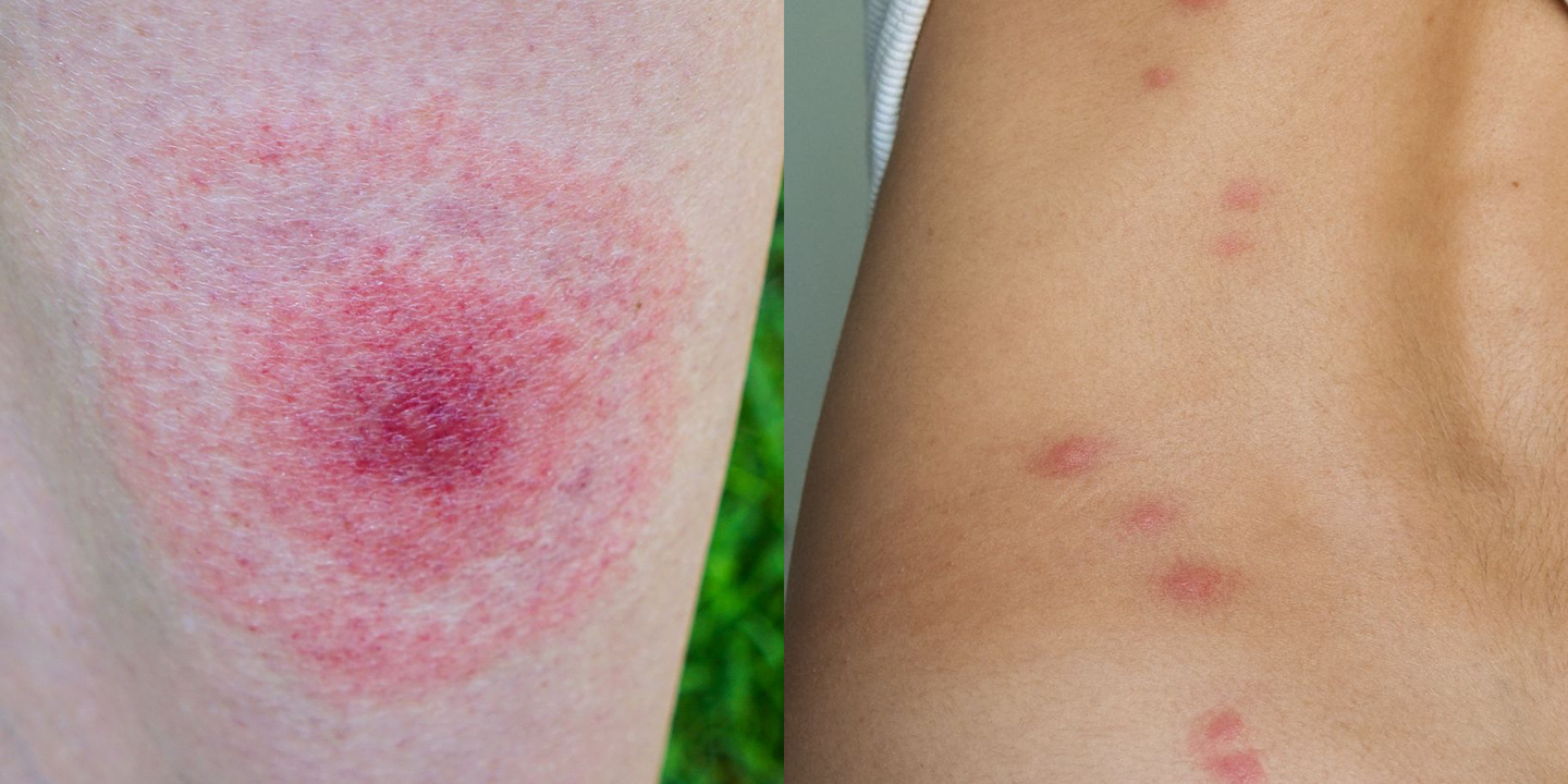 These Pictures Will Help You Id The Most Common Bug Bites This Summer 7818