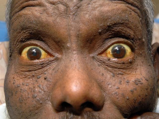 Jaundice is the yellowing of the skin and whites of the eyes (Rex Features)