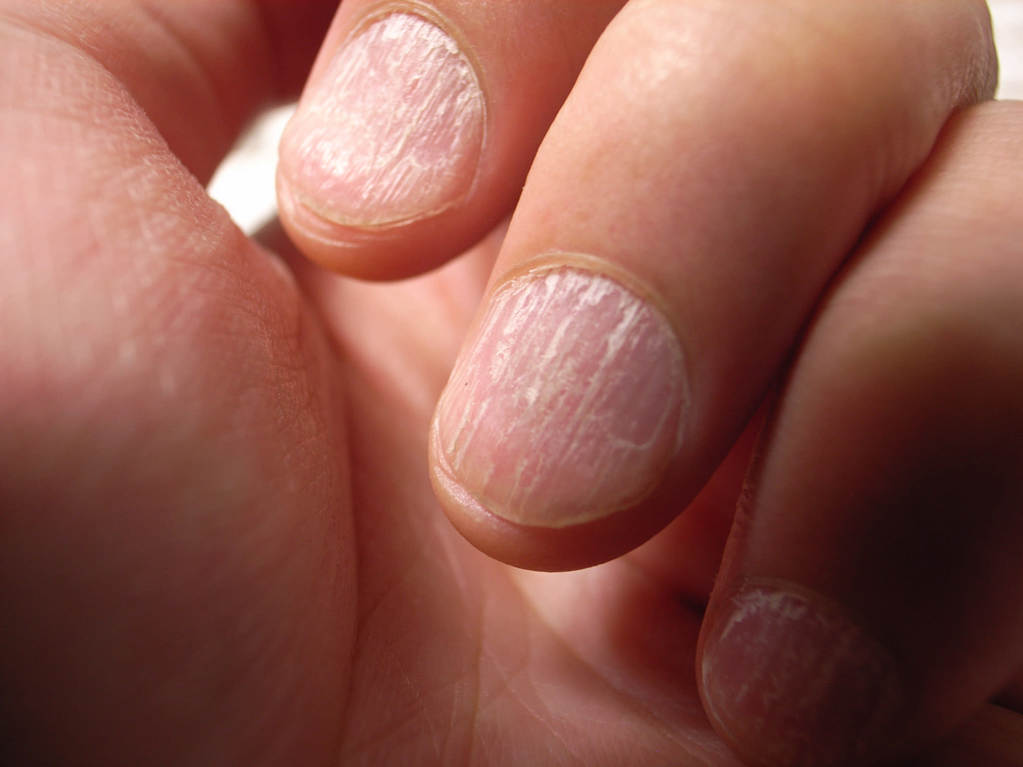 Common Nail Problems and How to Treat Them - wide 9