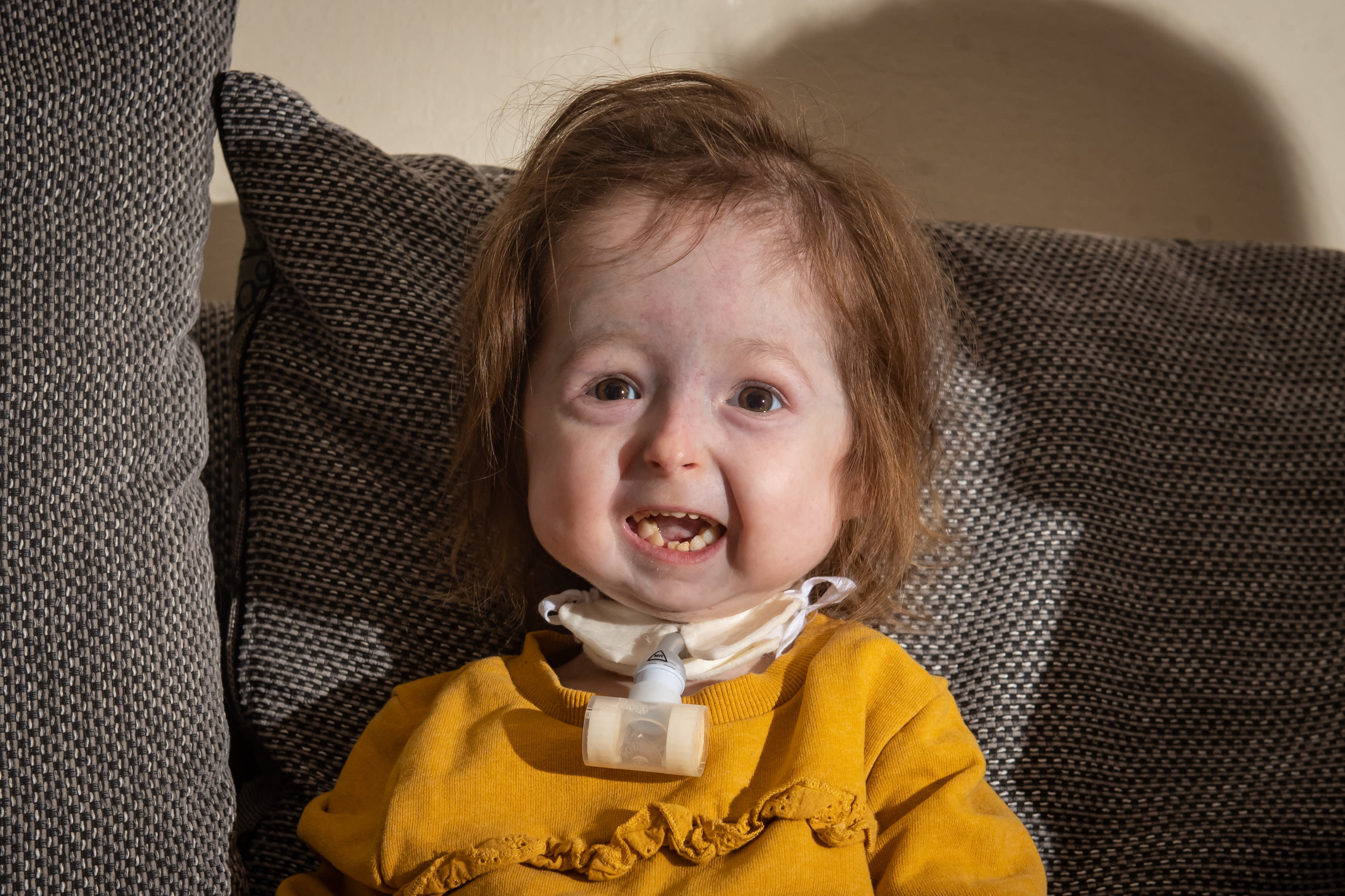 toddler-is-the-only-person-with-this-rare-ageing-disease