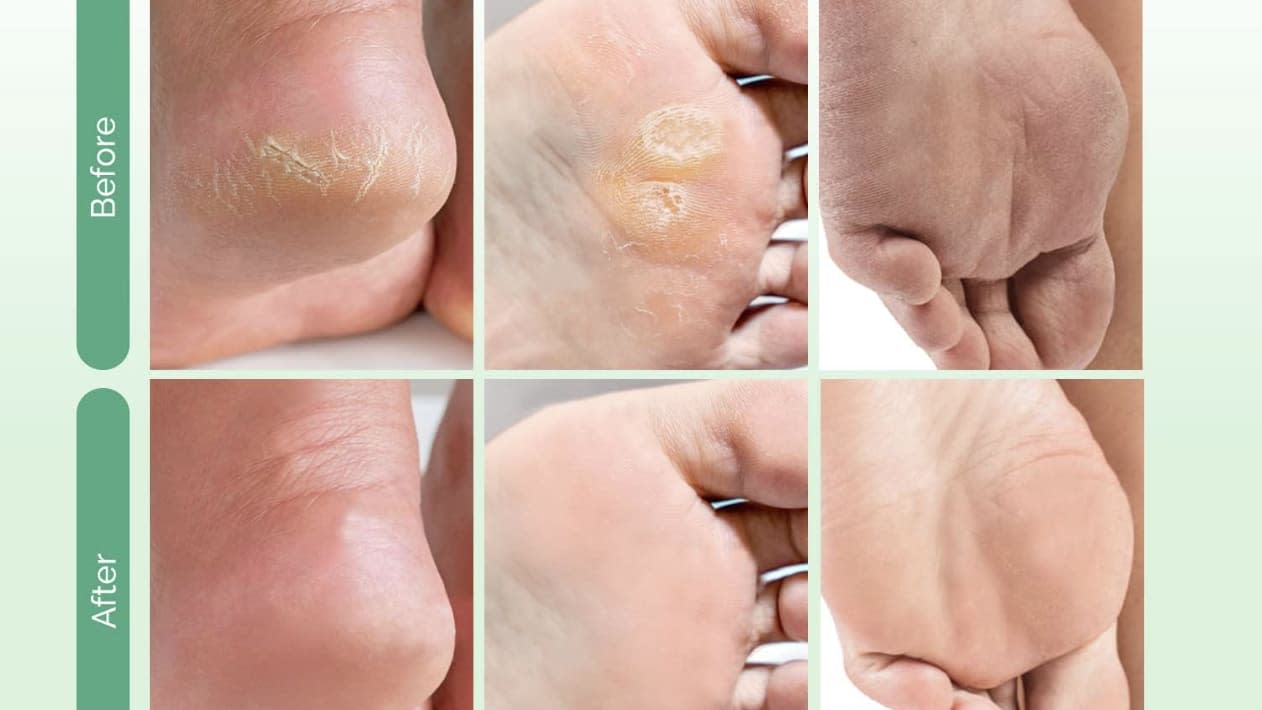 Ultra Exfoliating Foot Mask for Dry Skin