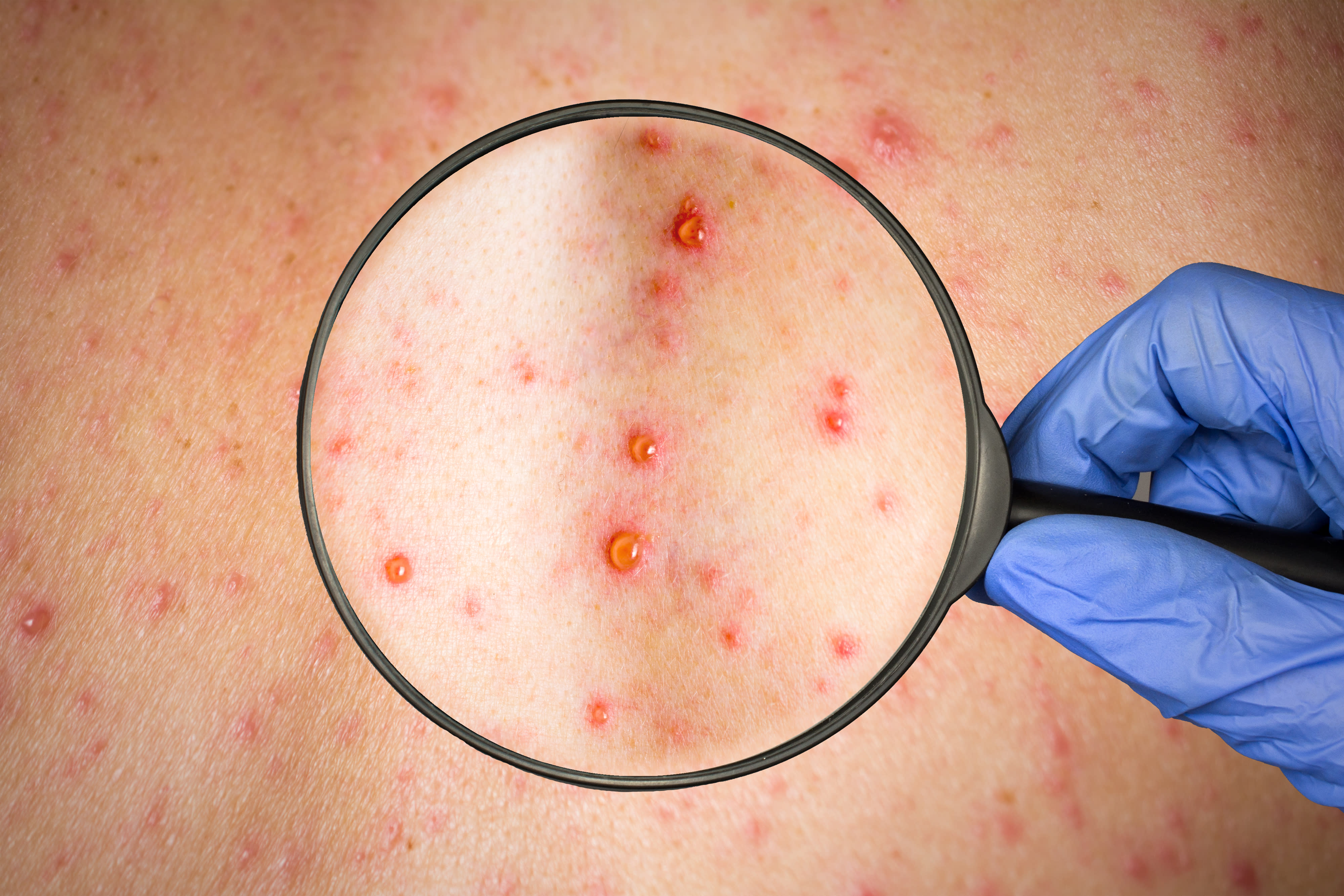 measles-rash-vs-chickenpox-what-remedies-to-take-all-things-health