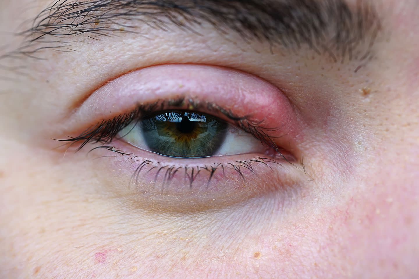 That Red, Painful Bump on Your Eye Probably Isn’t a Pimple