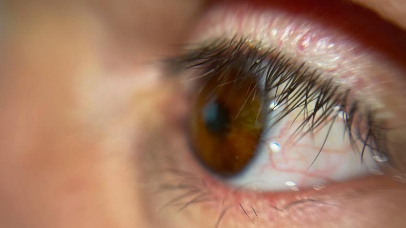 Patient receives a fully 3D-printed eye for the first time ever