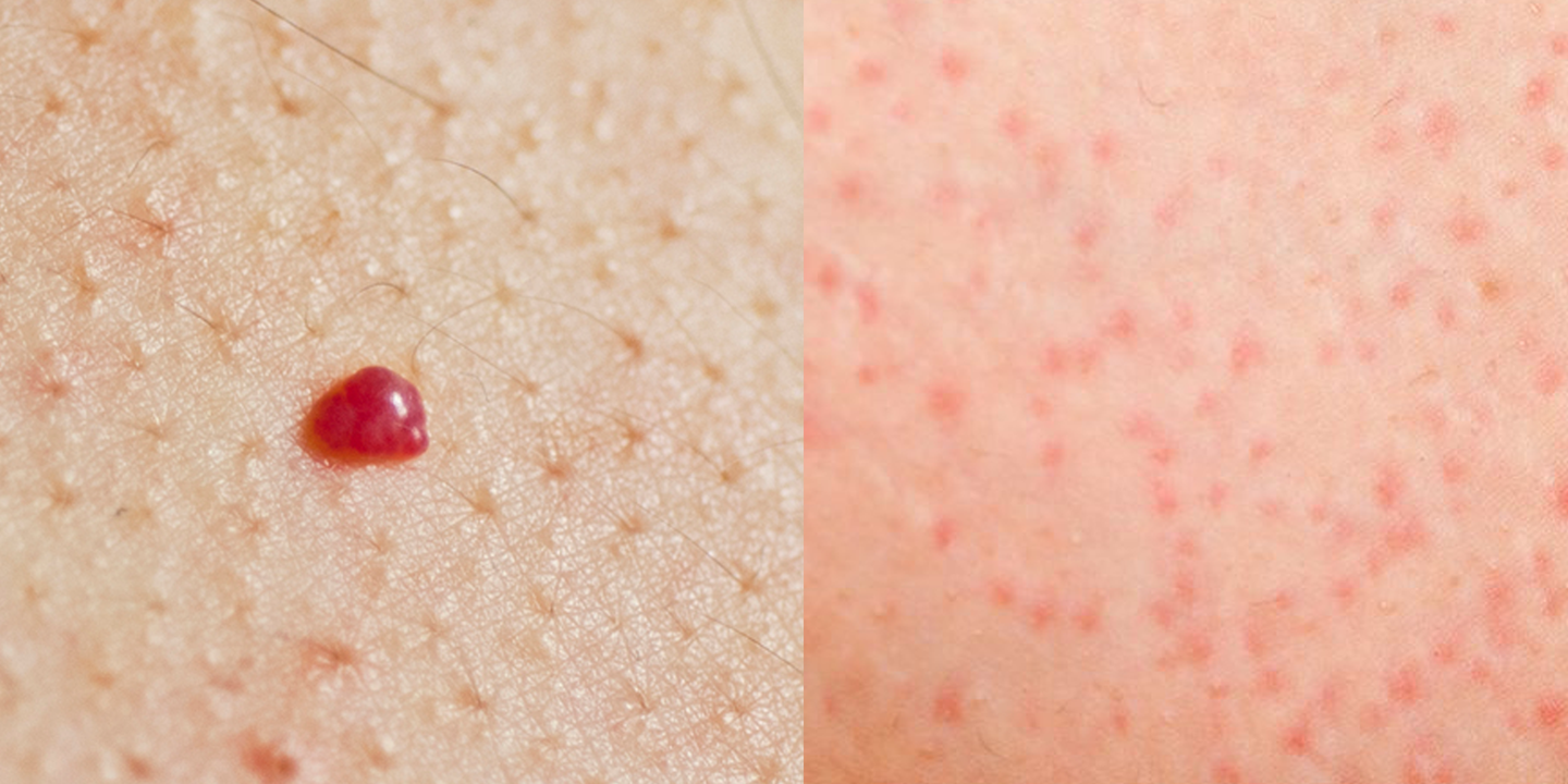 These Pictures Show Exactly What Those Annoying Spots On Your Skin   7360c74450b6c4bef9928915d3dc3c5a