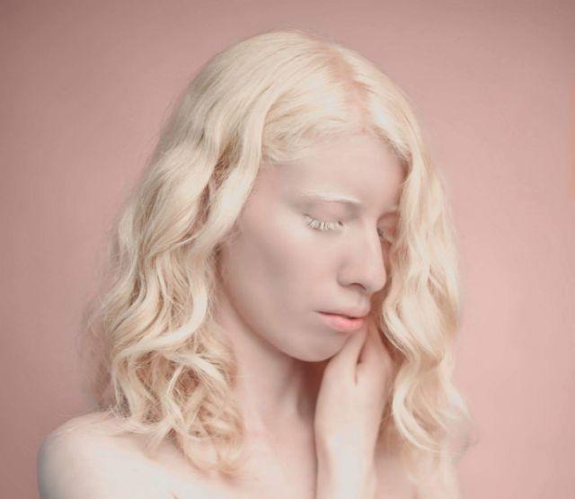 Ruby Vizcarra Albino Model