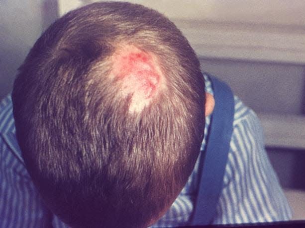 How you can contract ringworm and who is most likely to get infected