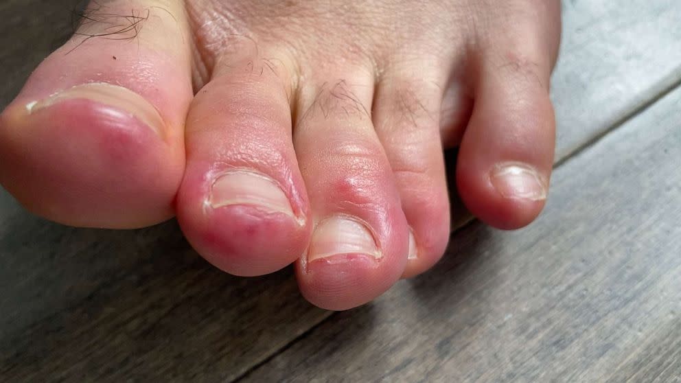 Covid Toes Could Skin Conditions Offer Coronavirus Clues