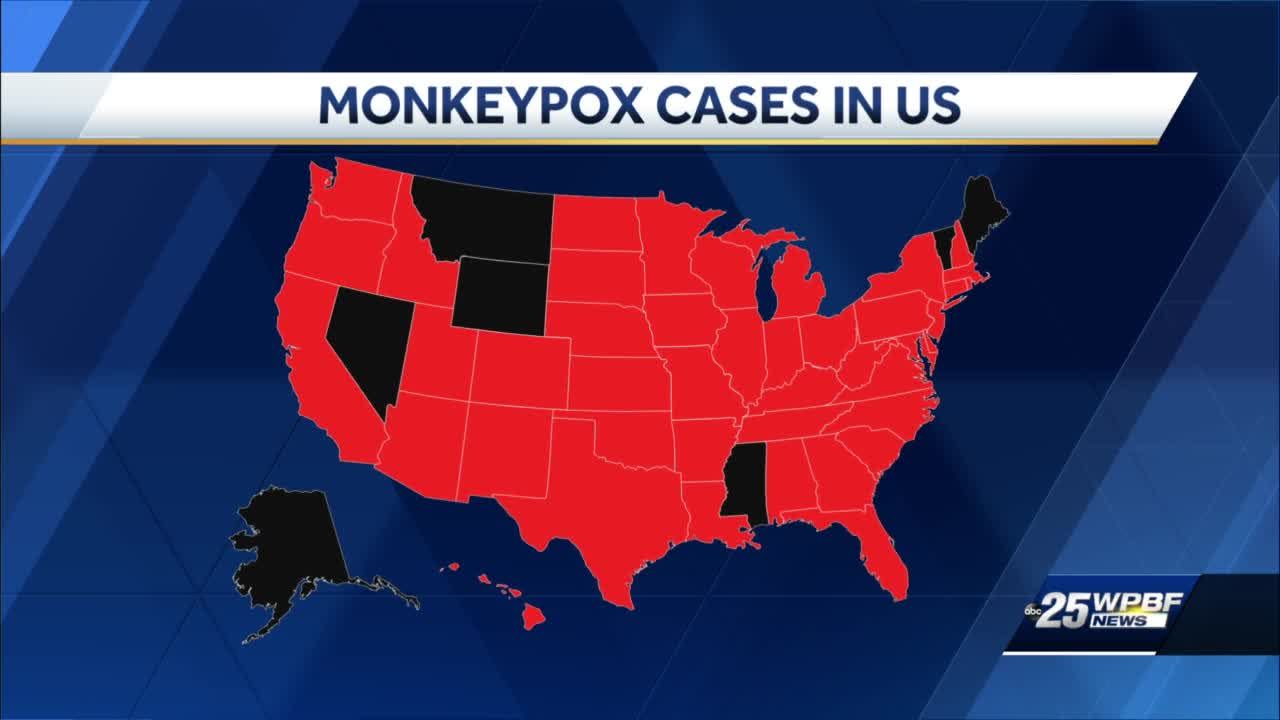 1st monkeypox case in US this year reported in Massachusetts - ABC News