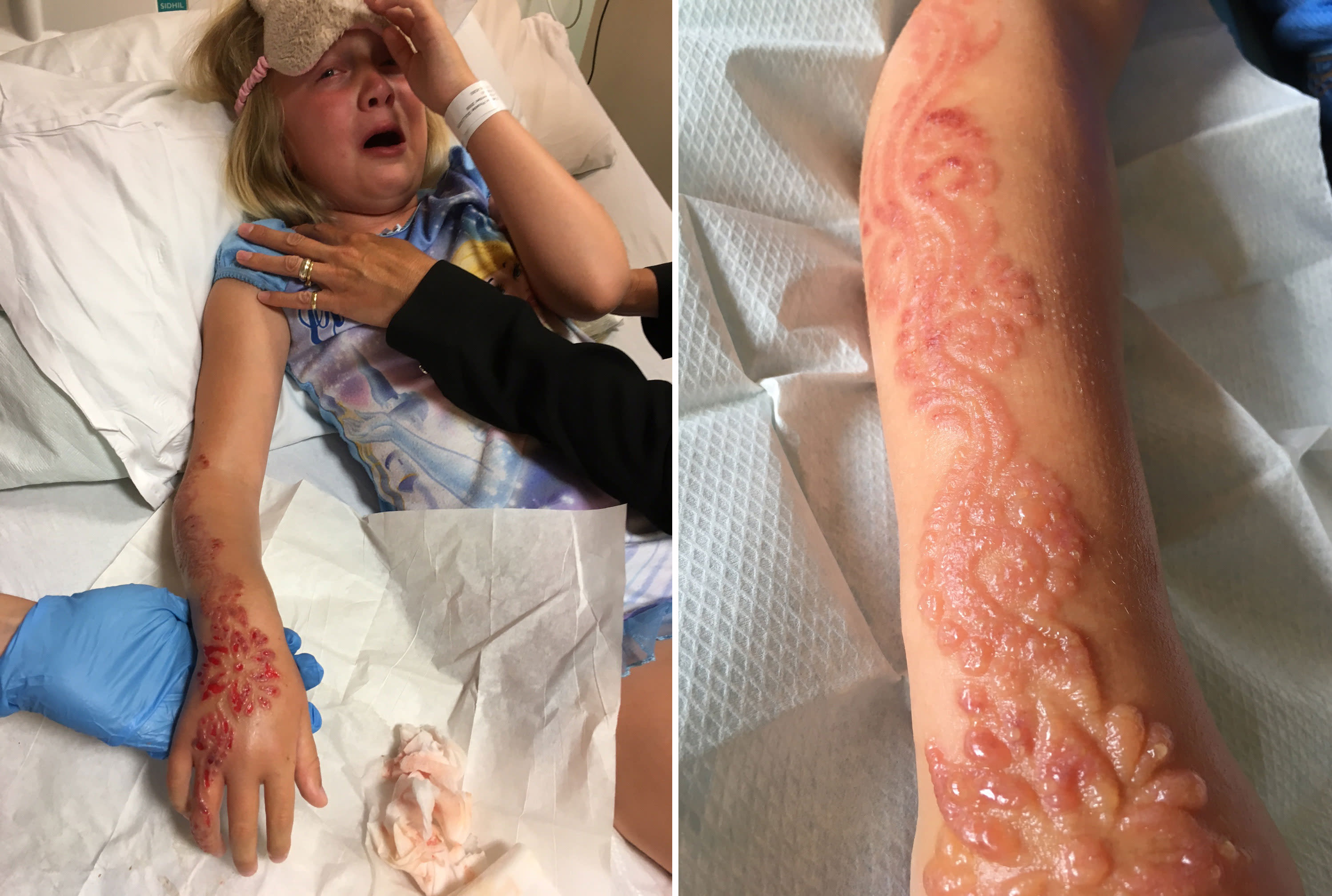 Young girl left with horrific burns and permanent scarring ...