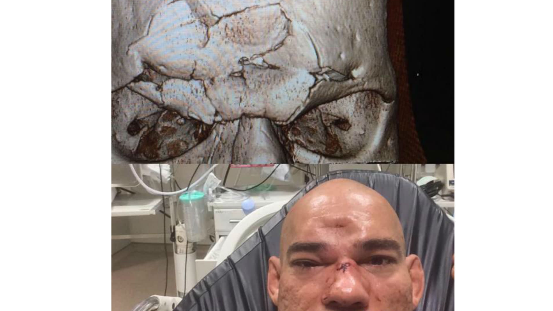 Cyborg Santos Suffers Gruesome Skull Fracture In Loss To Michael Page 4421