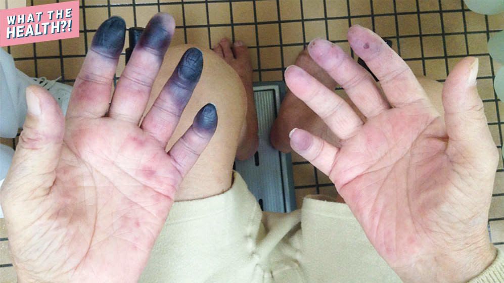 this-84-year-old-man-s-fingers-and-toes-turned-black-because-of