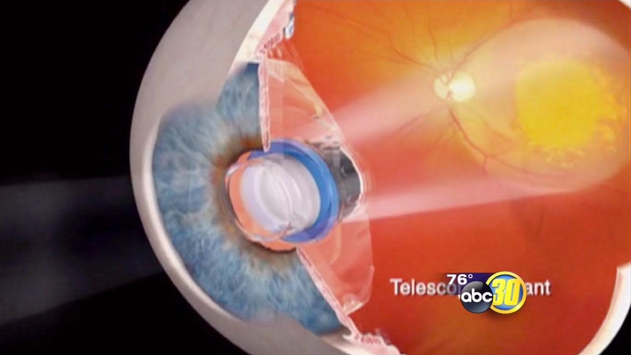 Macular Degeneration Implantable Telescope Improves