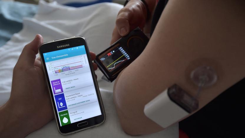 TO GO WITH AFP STORY BY ARNAUD BOUVIER
A diabetic patient holds a smartphone with an application which automatically calculates the good mix to match the needs of insulin, at the central hospital in Strasbourg, eastern France, on June 8, 2016.. An innovation that could change the lives of people with diabetes: an 'artificial pancreas', which injects the right amount of insulin and whose amount is calculated by a smartphone using a complex algorithm, is currently tested on forty-five patients in nine hospitals in France. (Photo by PATRICK HERTZOG / AFP) (Photo by PATRICK HERTZOG/AFP via Getty Images)