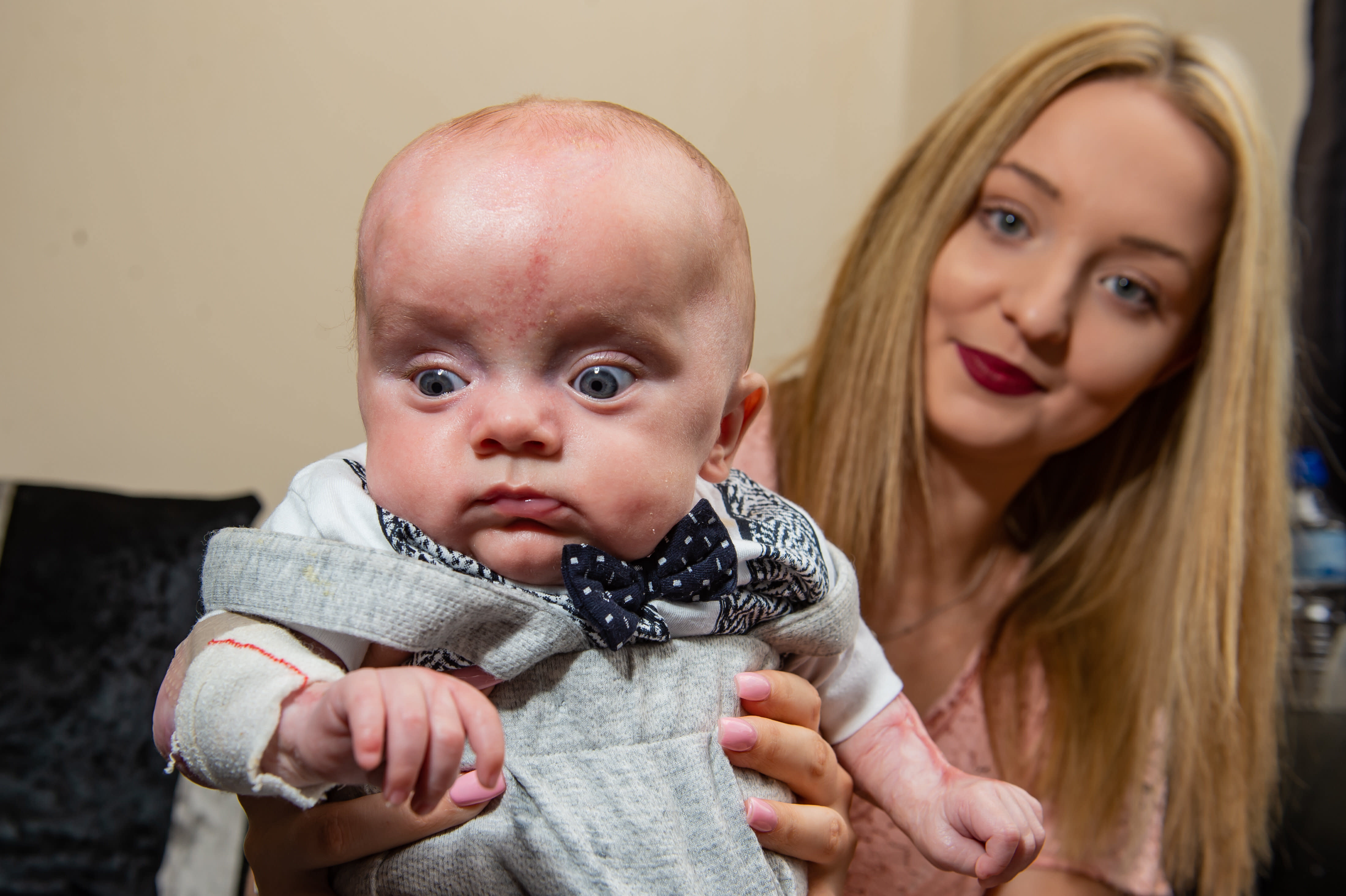 Baby born without skin defies doctors odds to survive